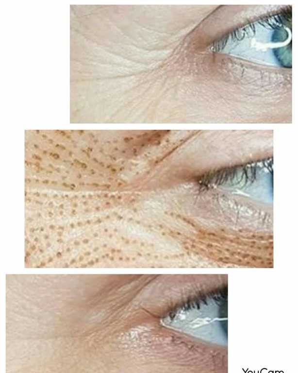Как убрать морщины под глазами? | блог expert clinics
