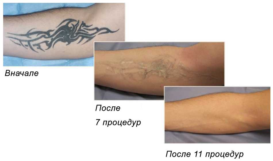 Удаление татуировки лазером tallinn, vitaclinika