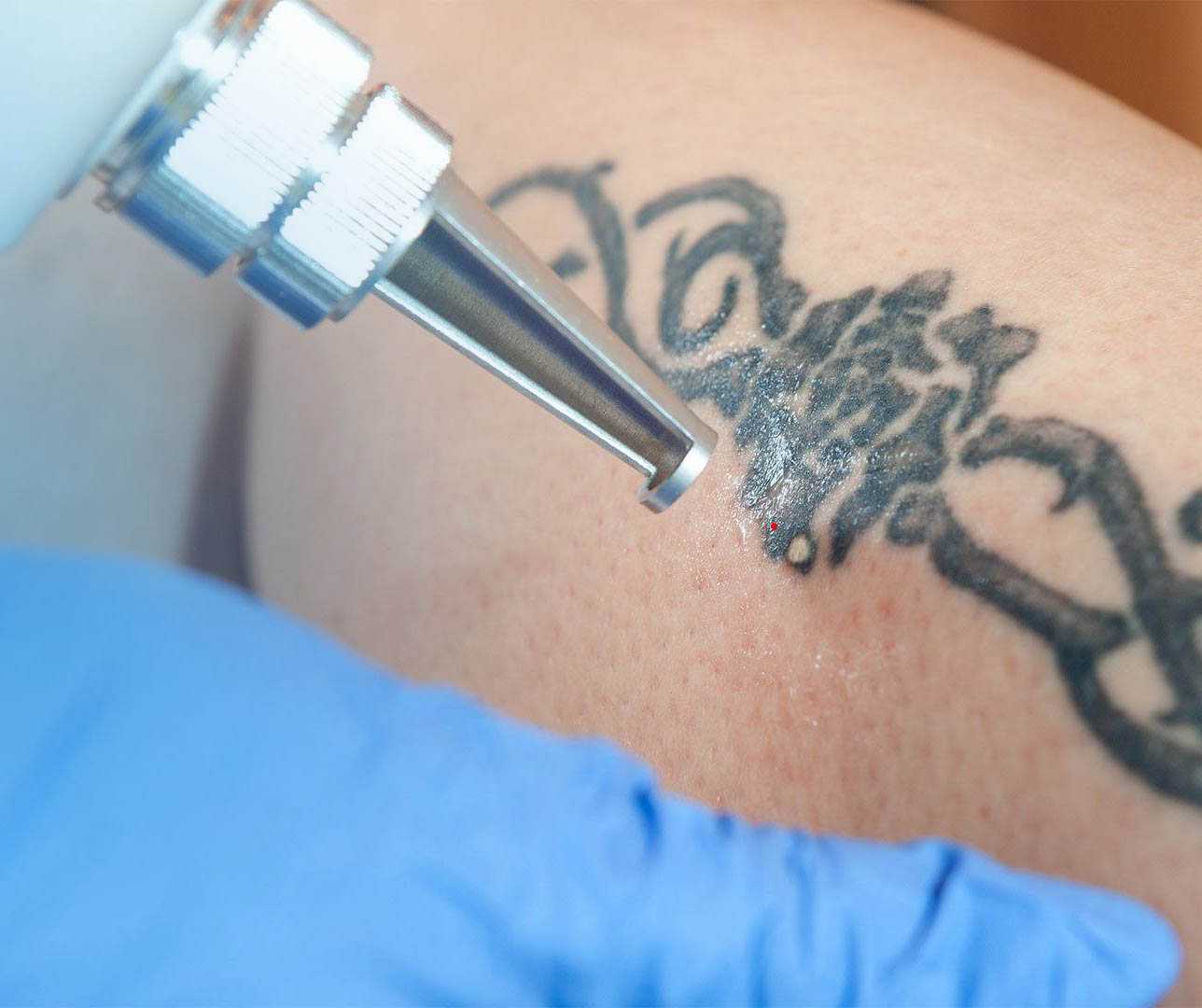 Советы по выбору лазерных аппаратов для удаления татуировок