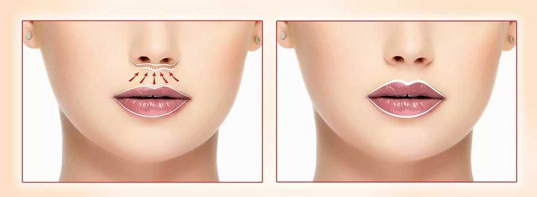 Наполнители белотеро или ювидерм – как выбрать лучший вариант для увеличения губ и заполнения морщин вокруг рта - клиника косметологии