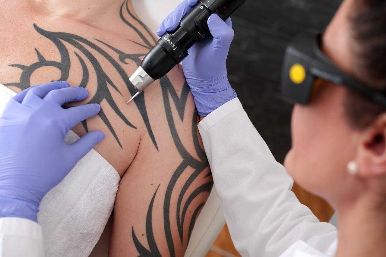 Удаление цветных татуировок хирургическим путем и лазером – методы, результаты, реабилитация