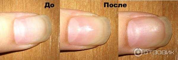 Как восстановить ногти после наращивания
