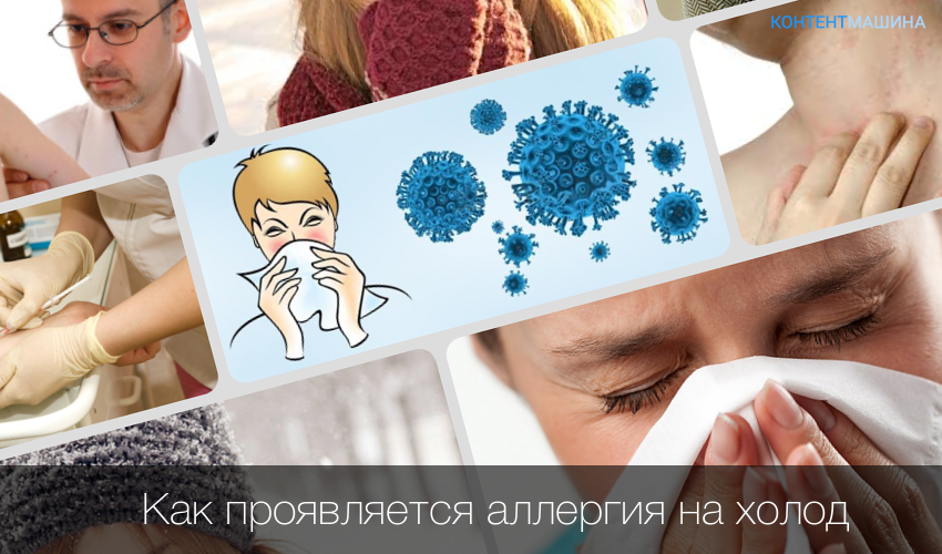 Аллергия на холод и мороз: лечение и симптомы