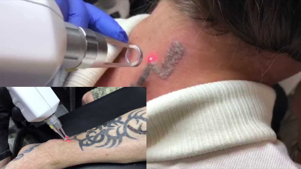 Остается ли шрам после удаления татуировки лазером?