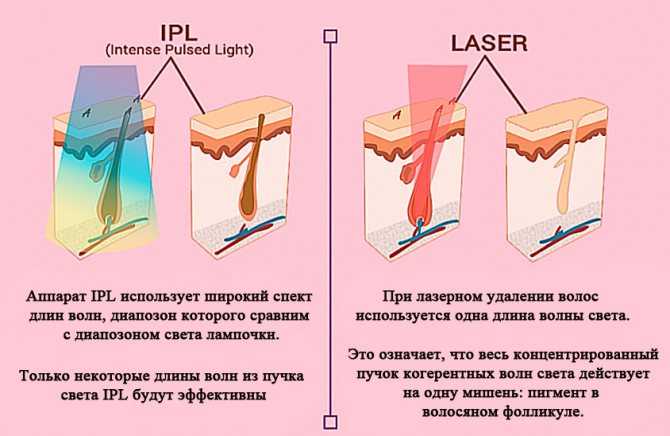 Советы по выбору лазерных аппаратов для удаления татуировок