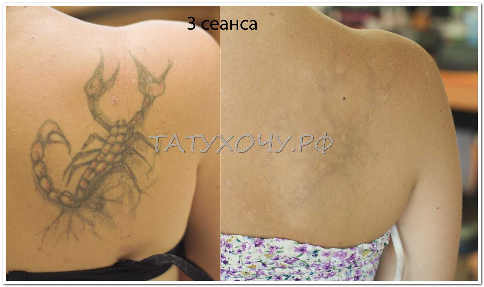 Последствия после удаления татуажа лазером – обзор с фото
