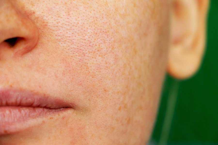 Жирная кожа лица: правильный ежедневный уход | блог expert clinics