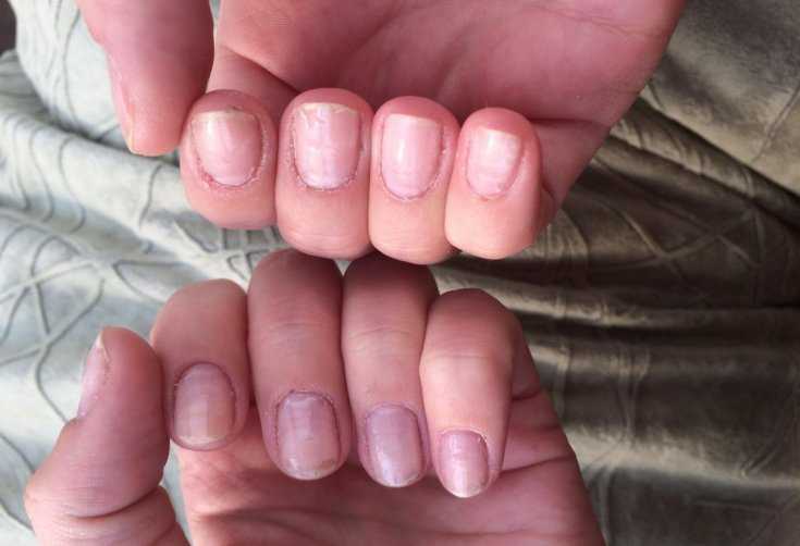 Простые правила как восстановить ногти после наращивания