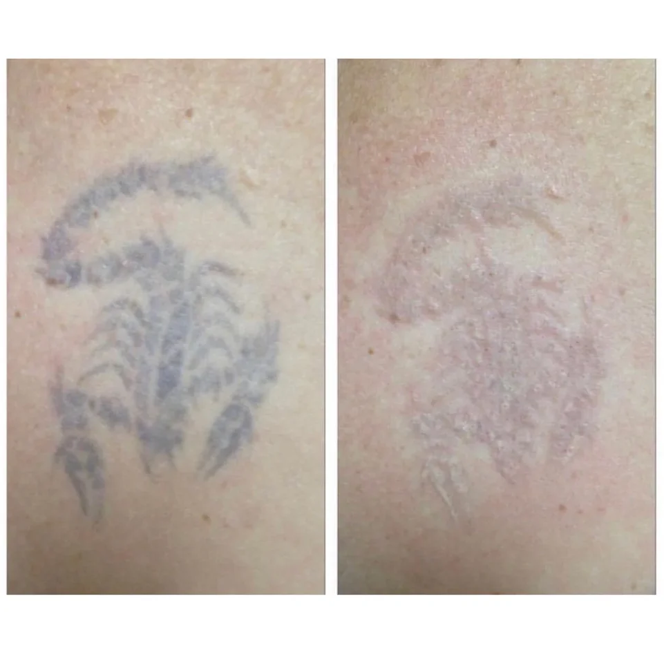 Как удалить старое тату. лазерное удаление татуировки лазером для последующего перекрытия с фото до и после