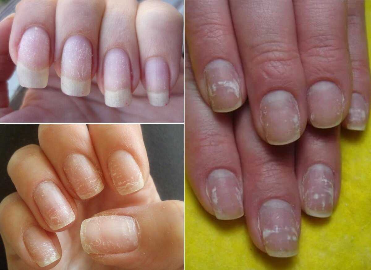 Как восстановить ногти после наращивания: все способы здесь!