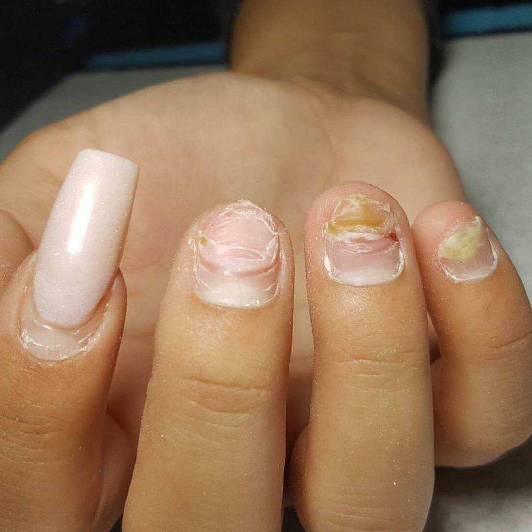 Как восстановить ногти после наращивания гелем: советы эксперта!