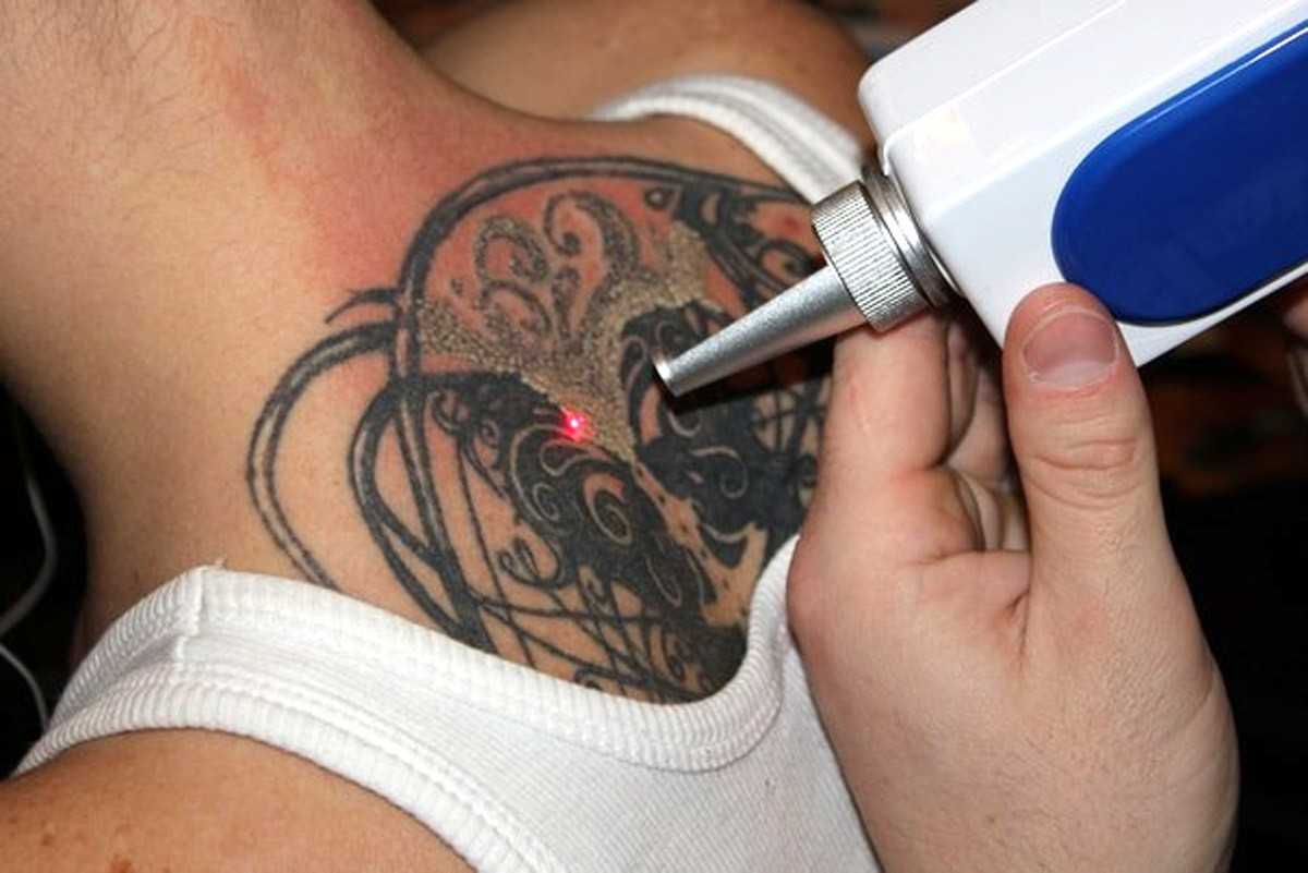 Методы удаления татуировок