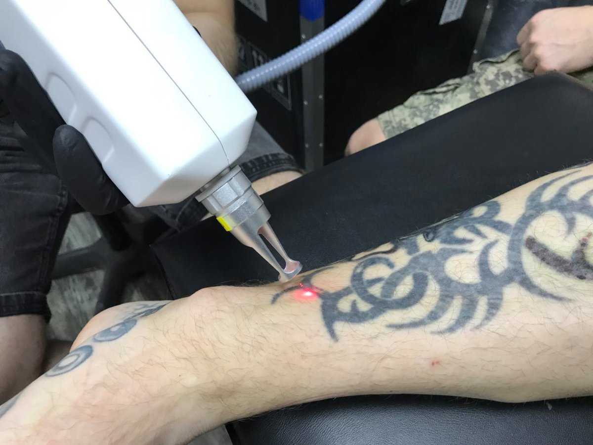 Неодимовый лазер для удаления тату: особенности и эффективность