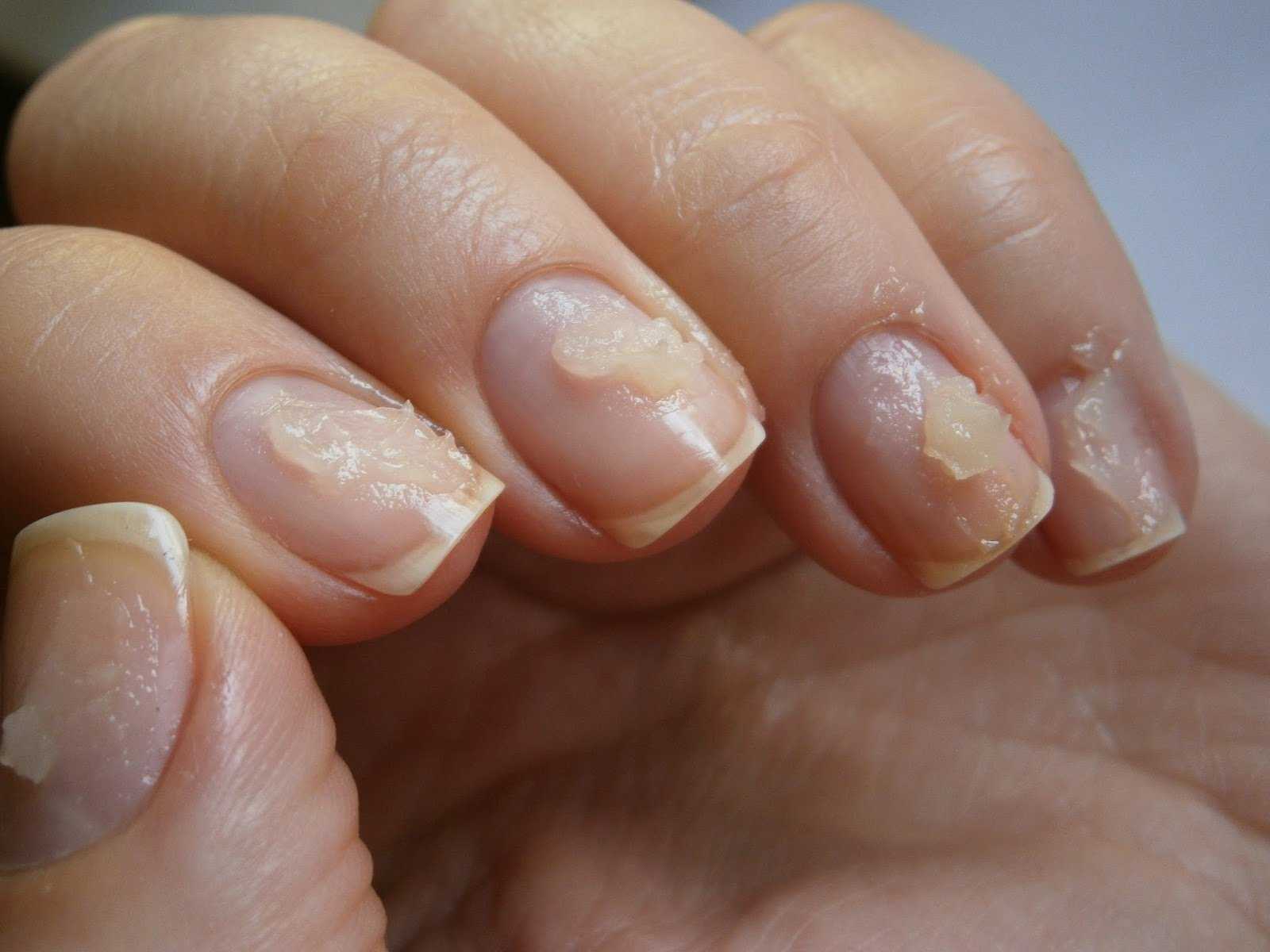 Как восстановить ногти после наращивания в домашних условиях: быстрые средства
