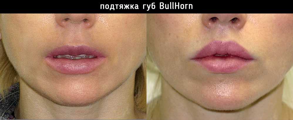 Реабилитация после увеличения губ: что нельзя и что можно? - блог клиники медиэстетик