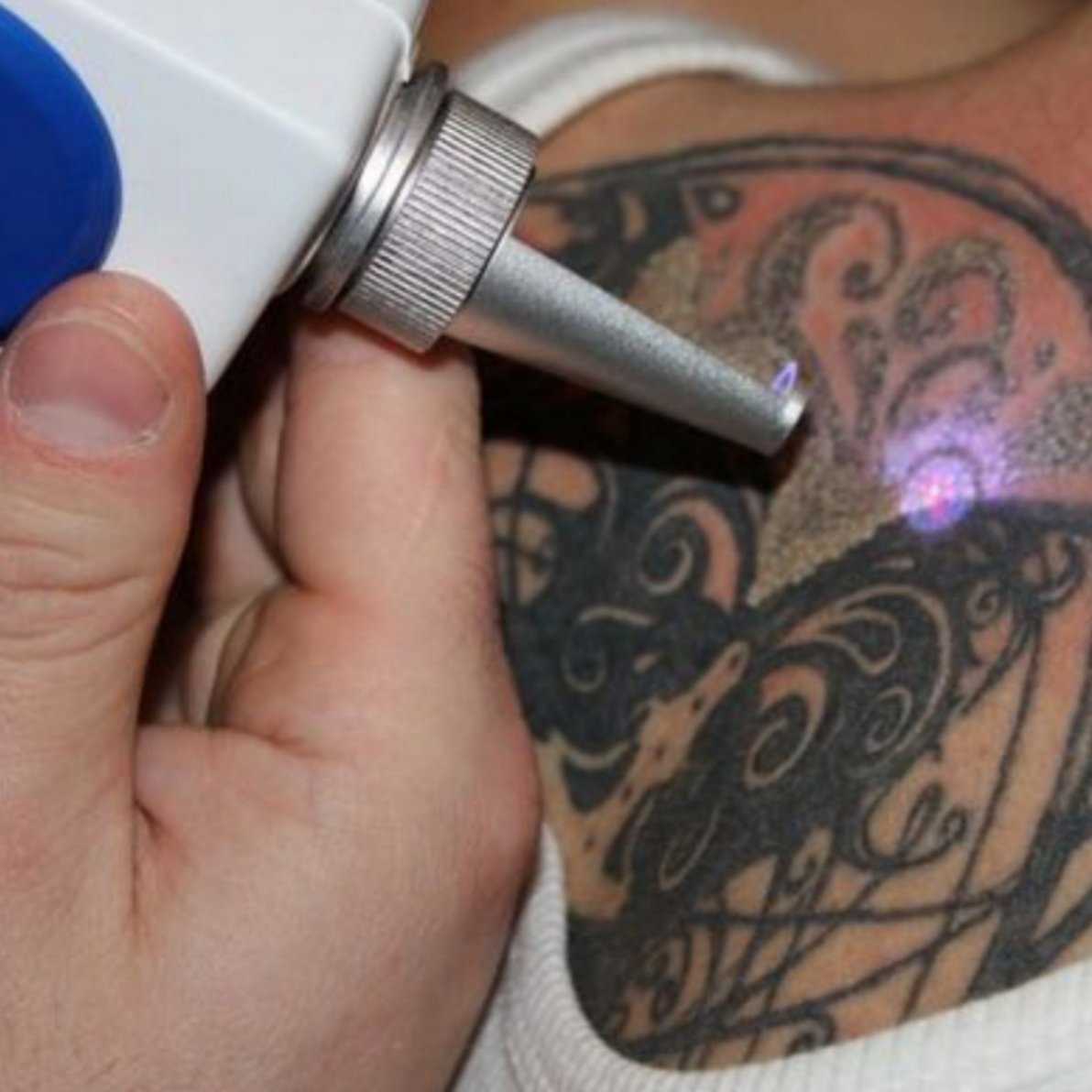 Лазерное удаление маленькой тату – количество сеансов