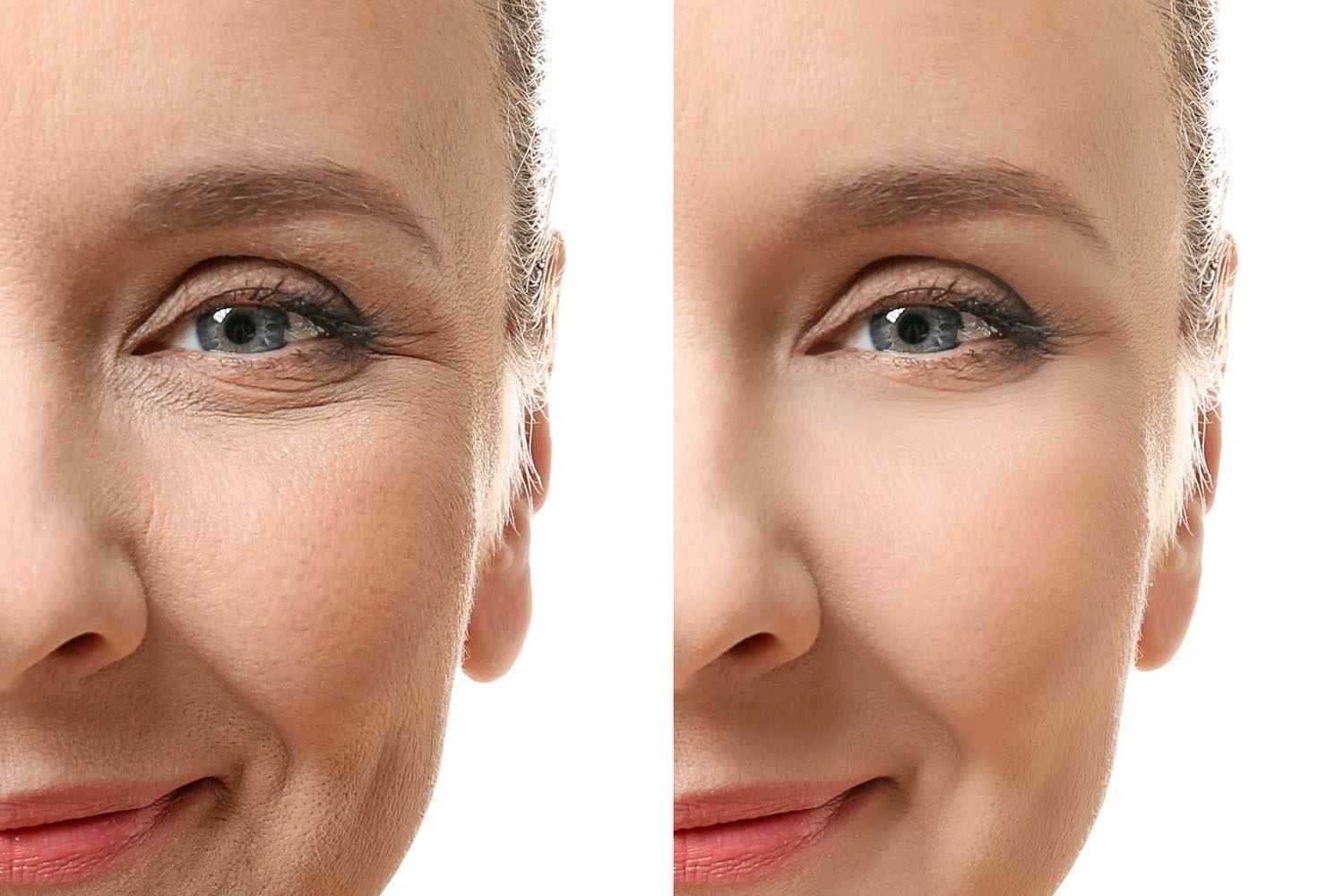 Как убрать морщины под глазами? | блог expert clinics