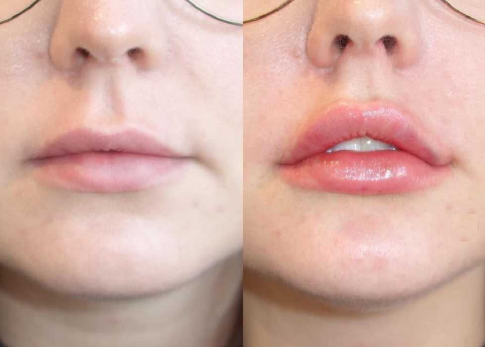 Увеличение губ гиалуроновой кислотой – 5 ошибок процедуры