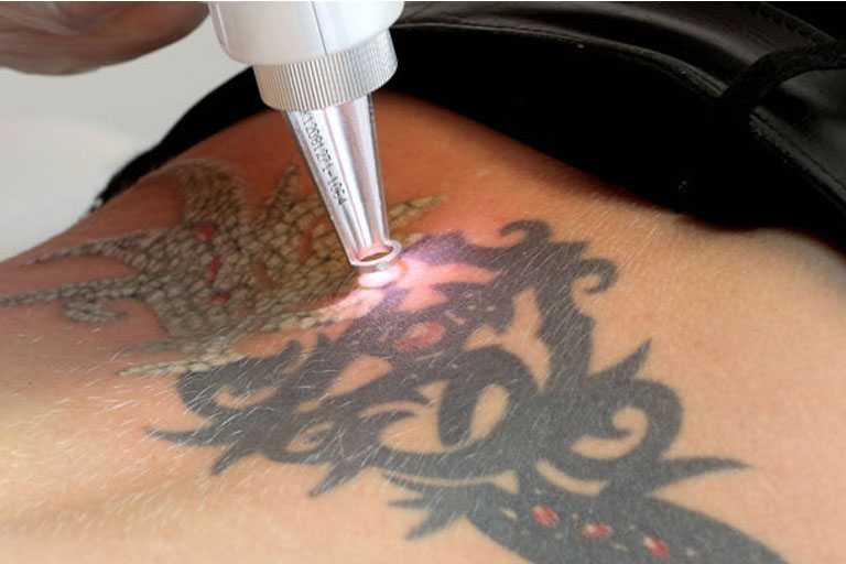 Можно ли делать лазерную эпиляцию на татуировке?